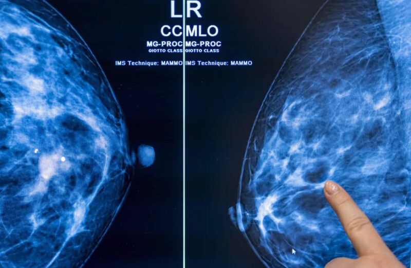 25 February 2022, Berlin: Medical personnel use a mammogram to examine a woman's breast for breast cancer. Photo: Hannibal Hanschke/dpa (Photo by Michael Hanschke/picture alliance via Getty Images)